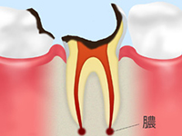 C4歯根の虫歯