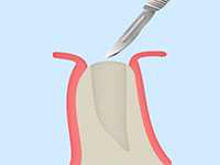 STEP1歯ぐきの切開