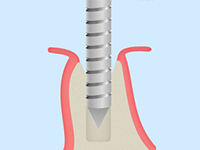 STEP2ドリリング