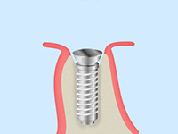 STEP3インプラントの埋入