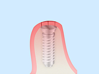 STEP4治癒期間