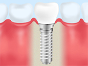 インプラントは治療後が大切です