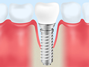 インプラントは治療後が大切です