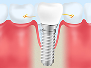 インプラントは治療後が大切です