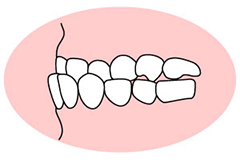 反対咬合（はんたいこうごう）